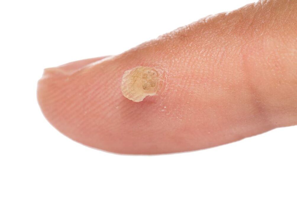 parmakta genital siğil